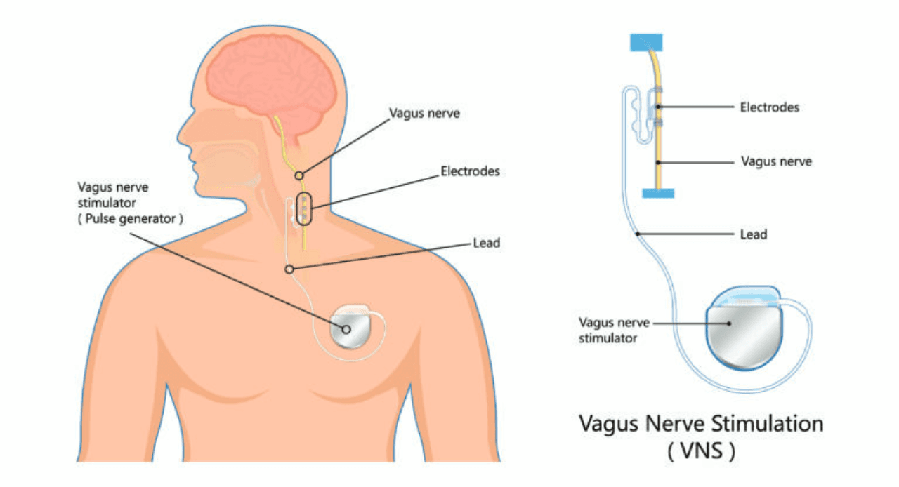 Vagus Nerve Stimulation: Tapping into Calm Naturally